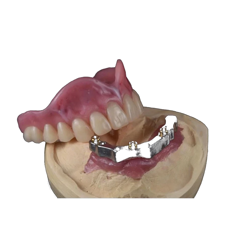 Milled custom implant bar photographed on a working model