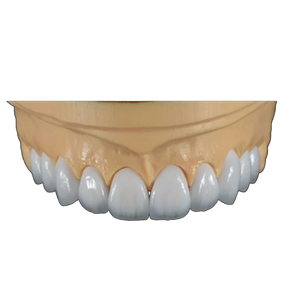 Lithium disilicate veneers shown on a working model