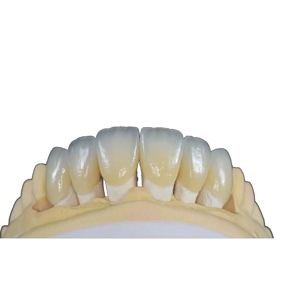 Hand-layered feldspathic porcelain veneers shown on a working model