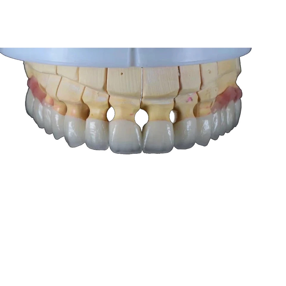 High-translucency zirconia crown finished on a working model