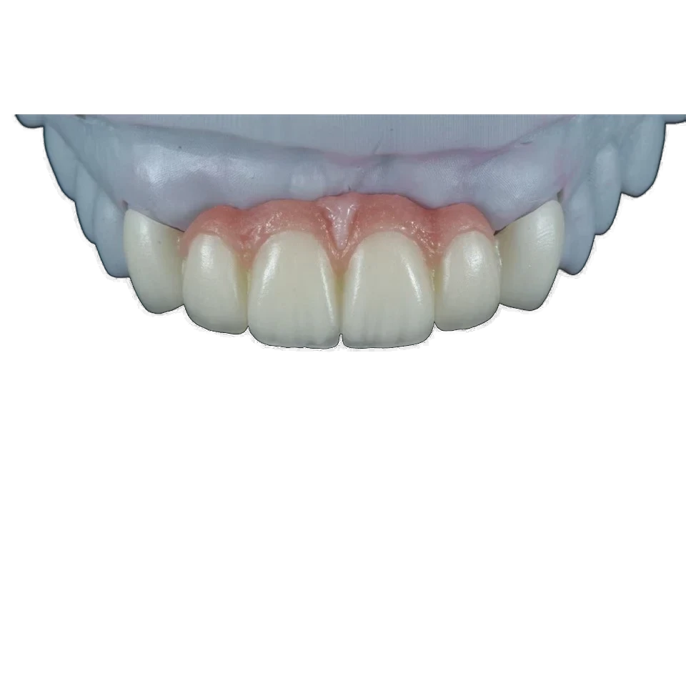 Implant-supported bridge with pink gingiva on a working model