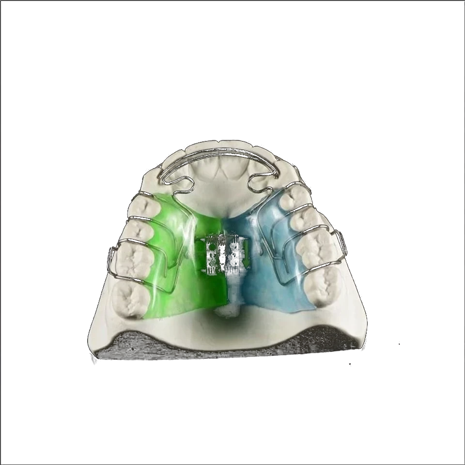 Removable orthodontic expander appliance with a central screw on a working model