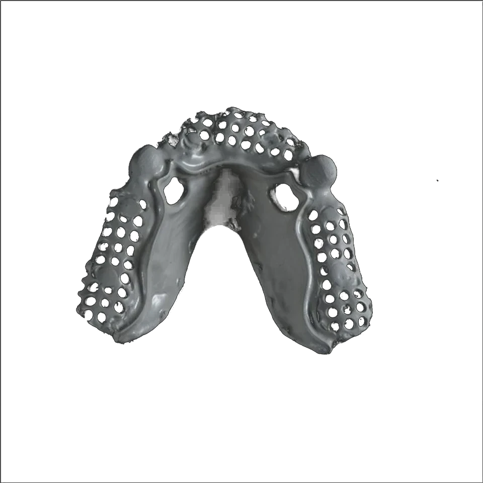 PEEK removable partial denture framework shown on a working model