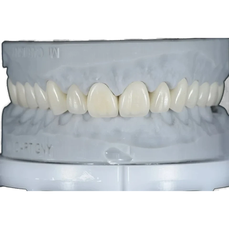 Pressed lithium disilicate crown on a working model