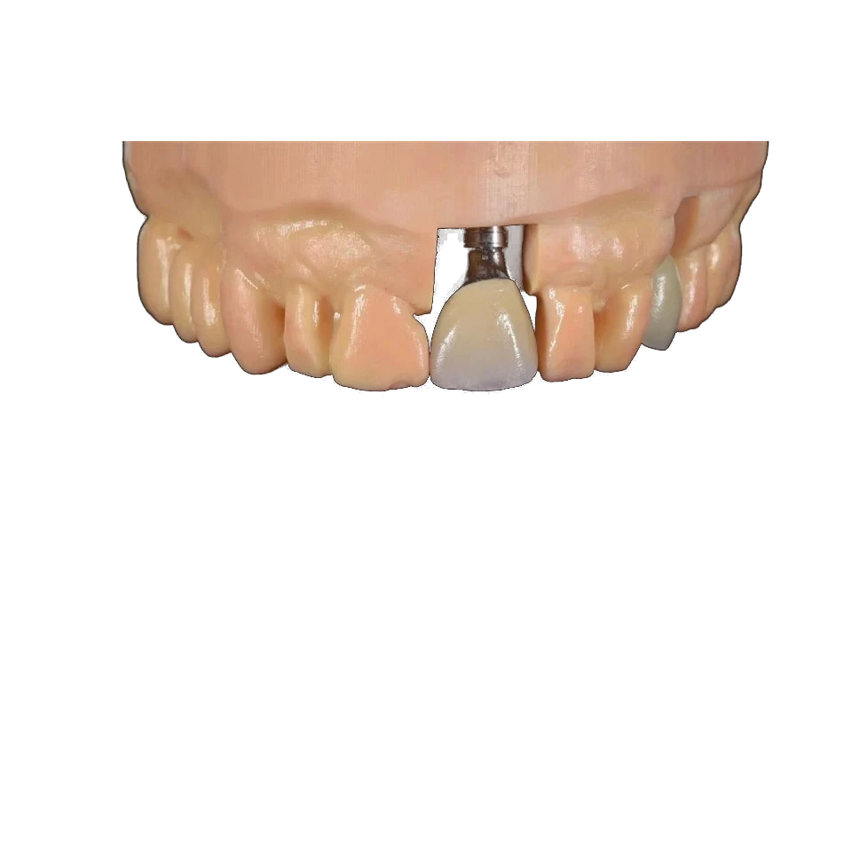 Screw-retained implant crown with an occlusal access channel
