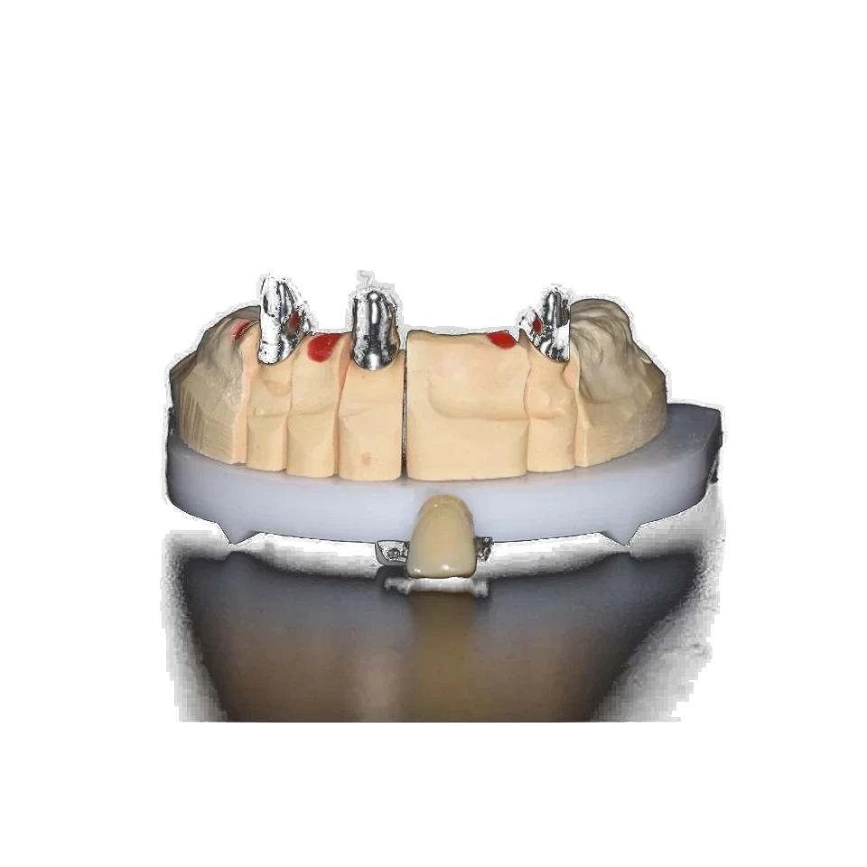 Telescopic denture framework with primary crowns on a working model